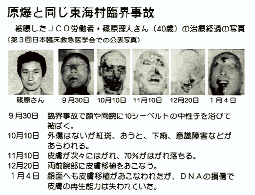 Hisashi Ouchi: A történelem legsúlyosabb sugárzási áldozata akarata ellenére 83 napig életben maradt! 5.