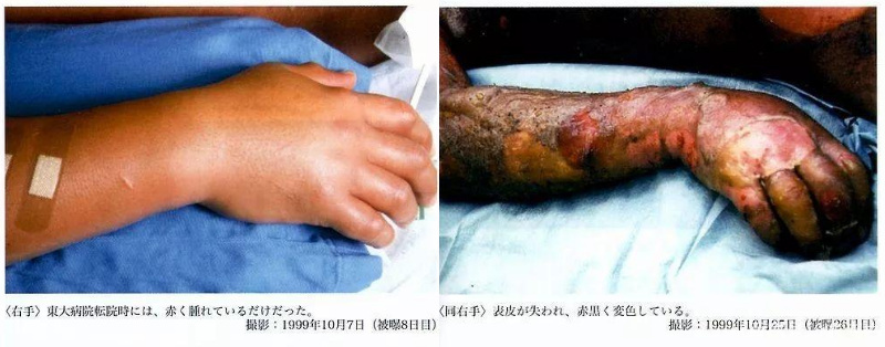 Hisashi Ouchi: Vēstures sliktākais radiācijas upuris tika turēts dzīvs 83 dienas pret viņa gribu! 4