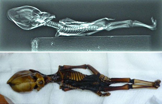 연구원들은 X-레이를 조사한 후 무릎의 골단판(어린이에게서만 발견되는 긴 뼈 끝에 있는 성장판)의 밀도를 기준으로 Aka의 골격 발달이 놀랍게도 6- 8세 아이에게. 그것이 사실이라면 두 가지 가능성이 있습니다. 하나는 장기적으로 Ata가 심각한 형태의 왜소증을 앓고 있었고 실제로 작은 인간으로 태어나 그 역년까지 살았다는 것입니다.