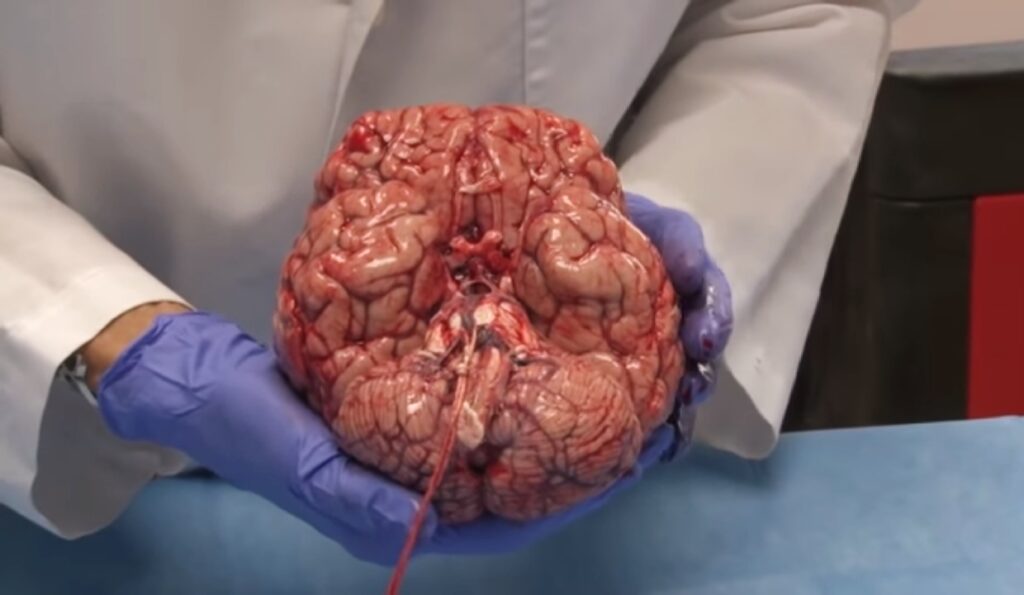 This video of a freshly removed human brain has fascinated the world 5