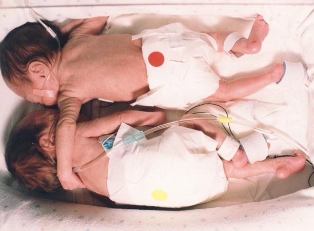 "Cái ôm giải cứu" - trường hợp kỳ lạ của cặp song sinh Brielle và Kyrie Jackson 1