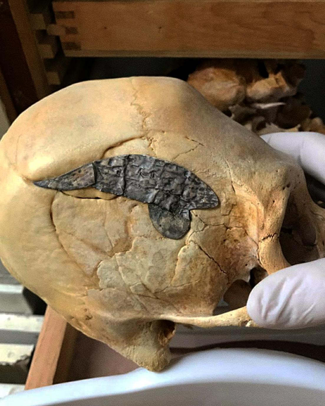 Peruansk långsträckt skalle som genomgick en skalloperation och fick metall kirurgiskt implanterad för att binda benen efter att ha skadats i strid för cirka 2,000 XNUMX år sedan
