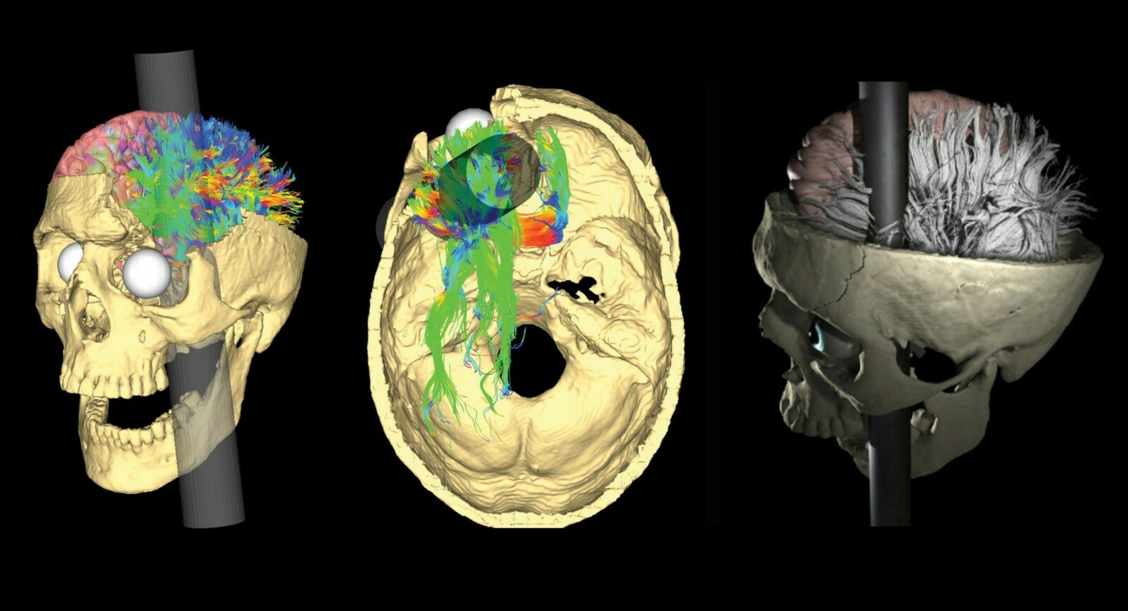 Images of the most recent reconstruction of the Phineas Gage case (2012). © Van Horn JD