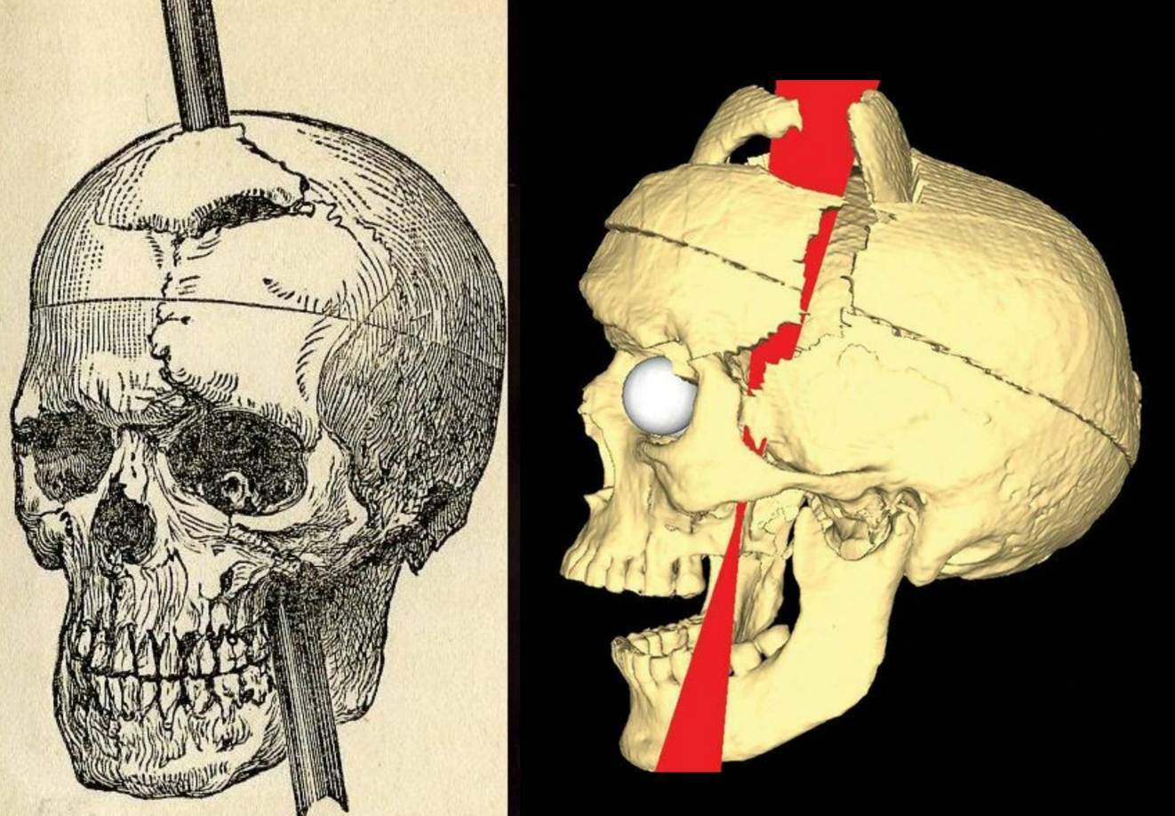Imaginea de reproducere a accidentului și fotografia craniului: inițial, nu au existat multe efecte secundare notabile din accident, dar un lucru care s-a dezvoltat în cele 12 zile de declin a fost o problemă cu jumătate din fața sa. În spatele ochiului stâng, pe unde trecuse vârful, a început să crească o infecție. Ochiul a început să se umfle și bucăți de creier și puroi infectate au ieșit din priză. Phineas a încetat să mai poată vedea din acel ochi și a dezvoltat ptoză sau o cădere a pleoapei. Această ptoză nu va dispărea pentru restul vieții sale. Cicatricile de la accidentarea inițială au rămas și ele. De fapt, mulți mușchi din partea stângă a feței sale nu și-au mai revenit complet, lăsându-l cu puțină mișcare pe acea parte.