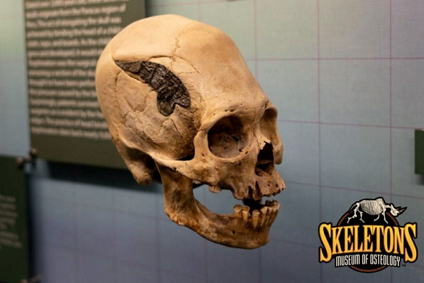 Deze schedel uit Peru heeft een metalen implantaat. Als het authentiek is, zou het een potentieel unieke vondst uit de oude Andes zijn.
